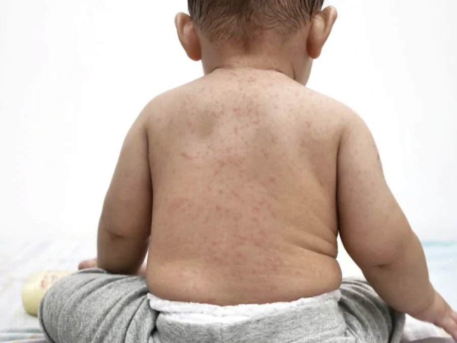 Measles Cases Rising in South Africa: What You Need To Know